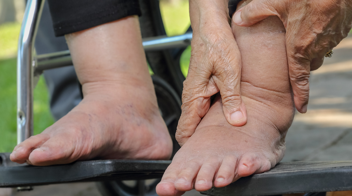 swollen ankles in elderly